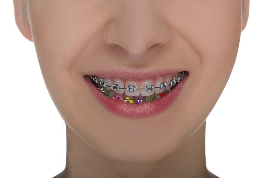 braces-color-picker