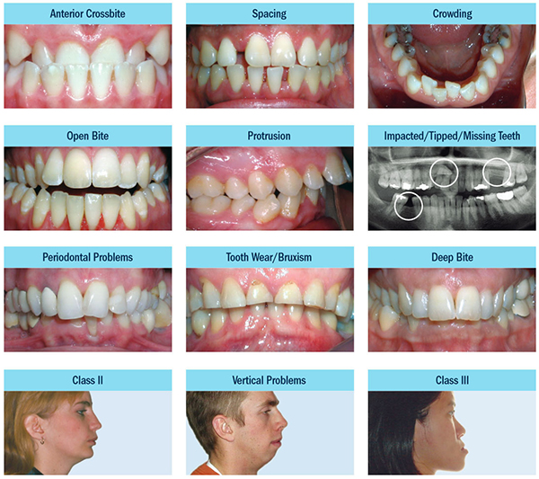 common orthodontic problems