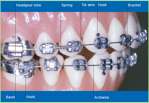 Brackets Hooks Bracket Door Archwire O-tie or Ligature Power Chain