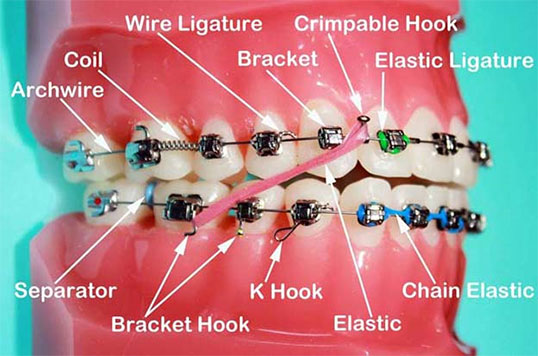 Body braces for body parts: What are the different types and how do they  work?, by Johnsansmith