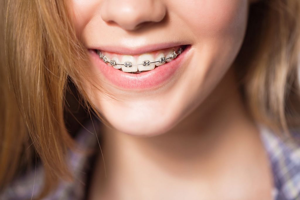 https://www.bordentownbraces.com/wp-content/uploads/2020/08/parts-of-braces-full-1024x683.jpg