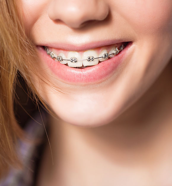 parts of braces