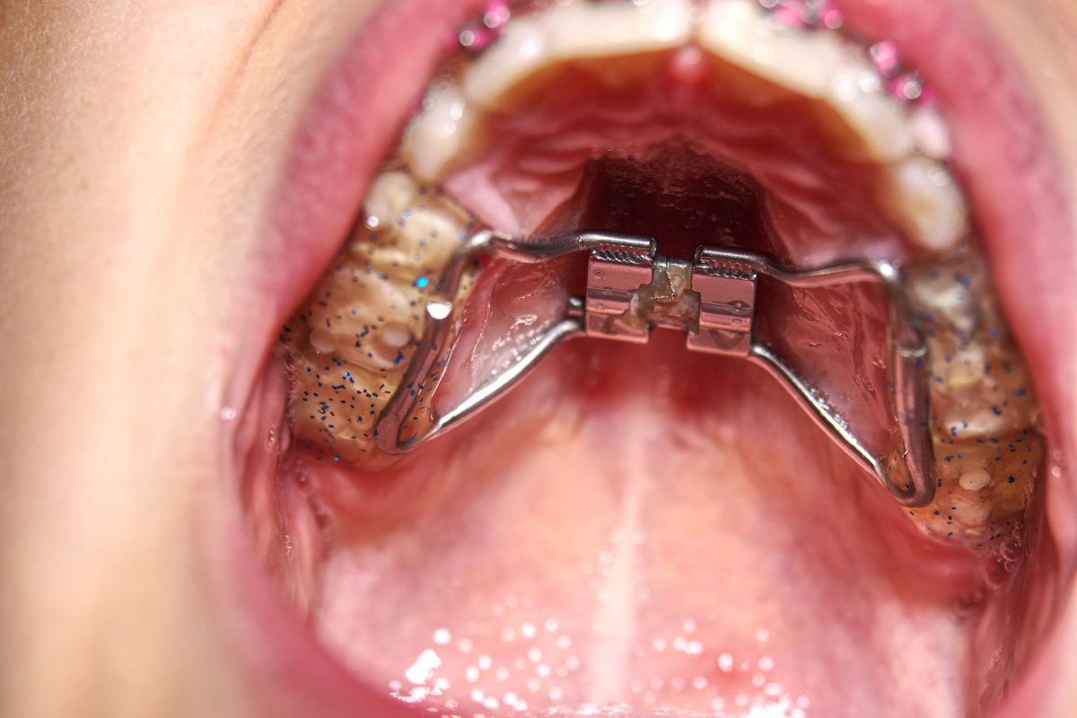 https://www.bordentownbraces.com/wp-content/uploads/2021/05/palatal-expanders-FAQ-1200x800.jpg