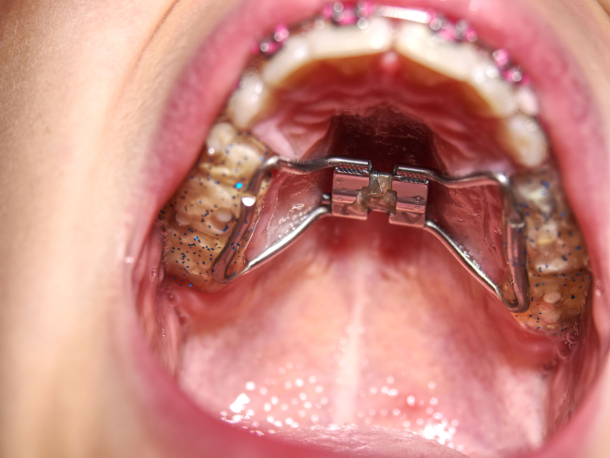 Palatal Expanders FAQ - Everything You Need to Know