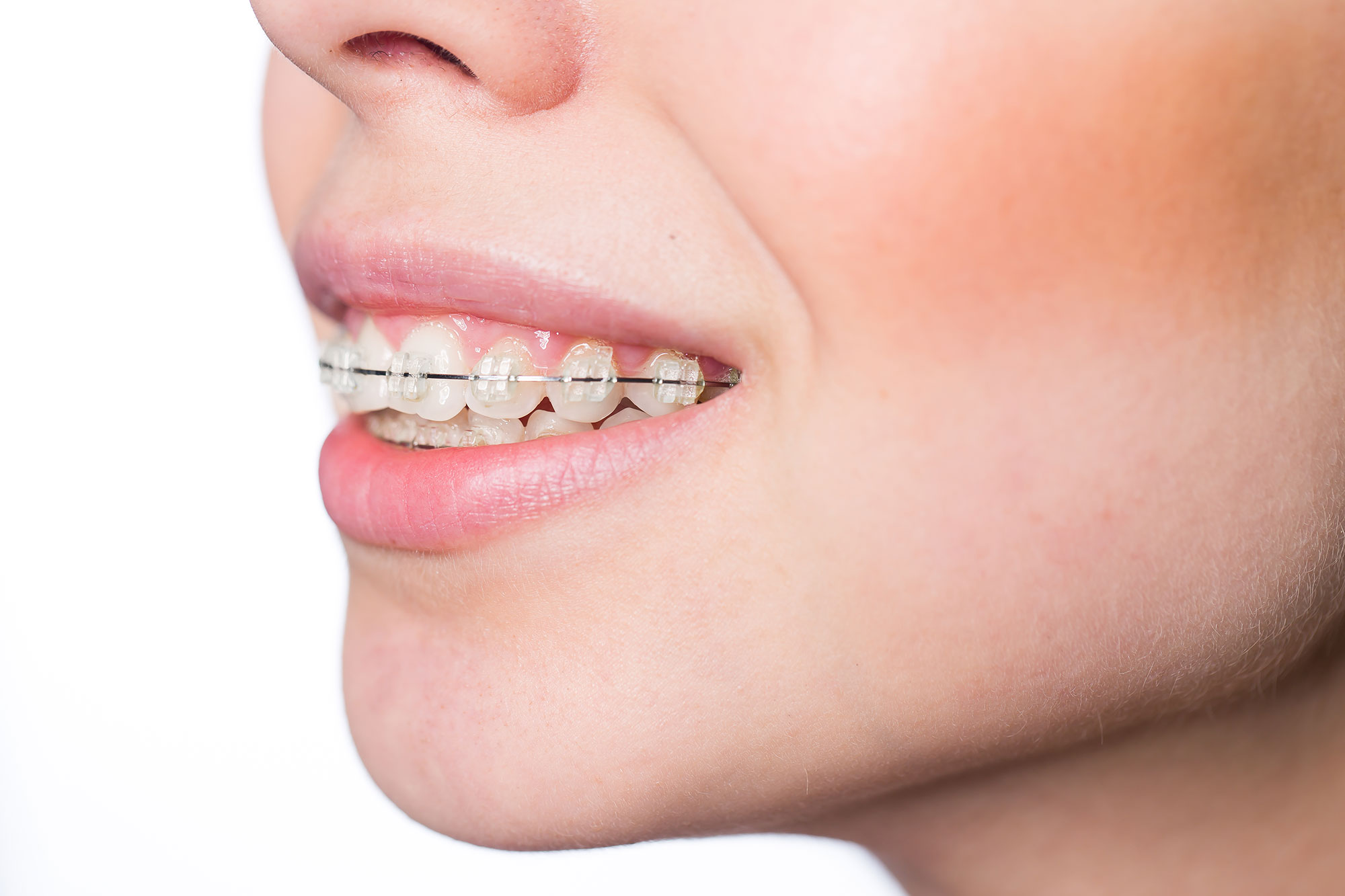 What Is an Overbite? - Bordentown Braces