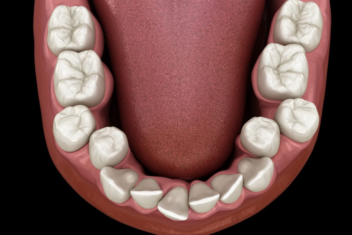 Crossbite Teeth