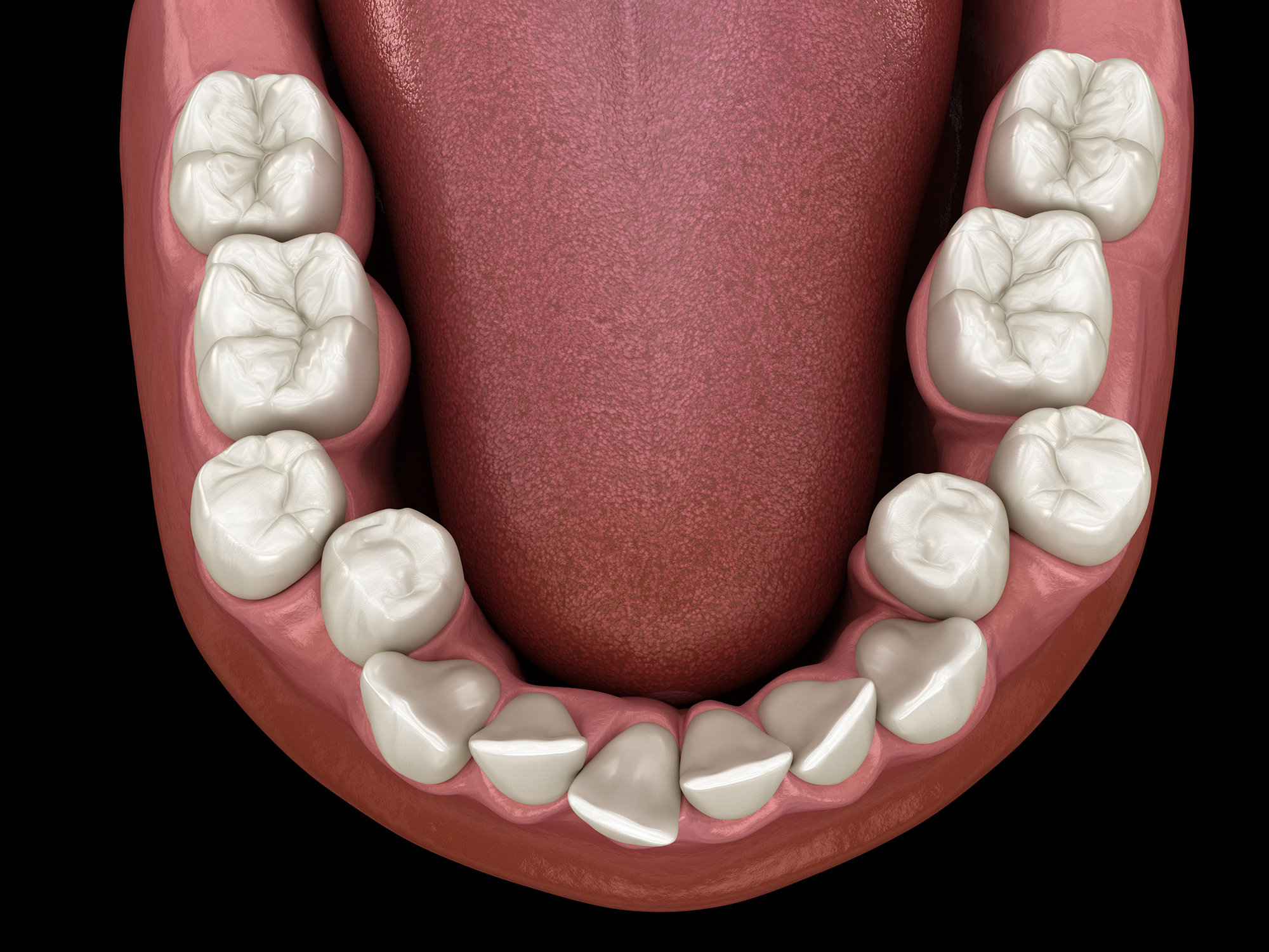 8 Symptoms of a Crossbite in Your Teeth Bordentown Braces