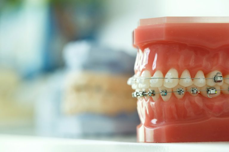 How to Keep Your Mouthguard Over Braces Stable