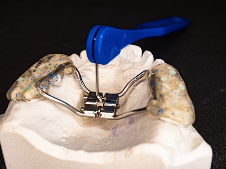 palate expander