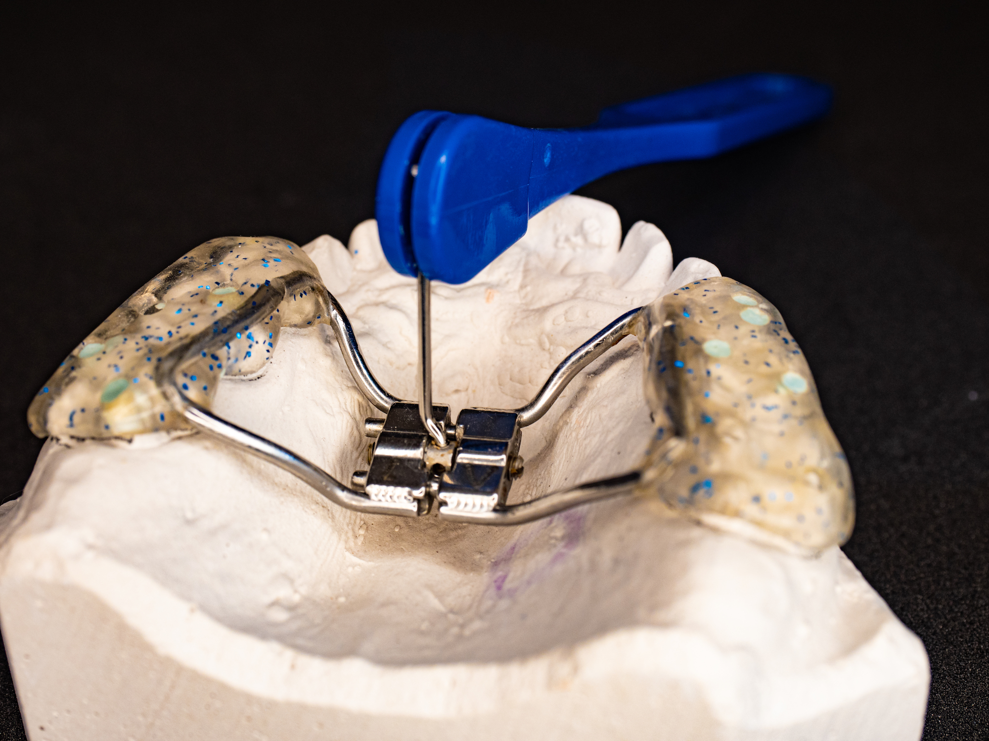 Understanding the Benefits and Process of Palate Expander