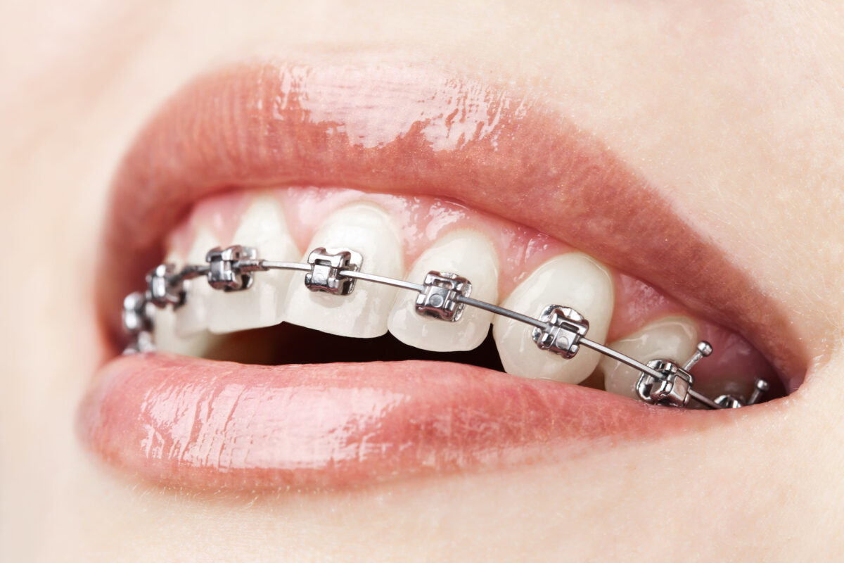 common-orthodontic-issues