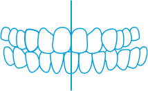 Crossbite