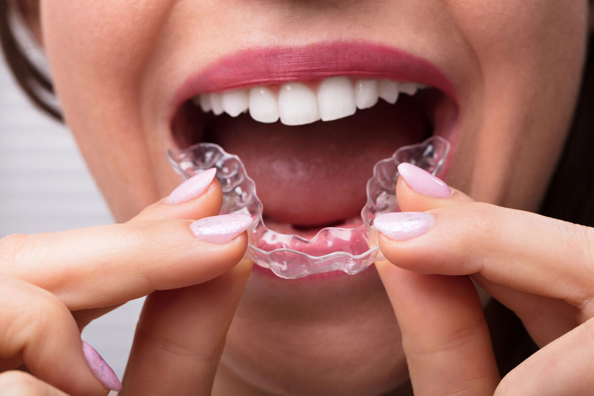 Retainers