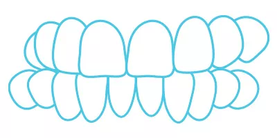 Crossbite