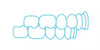 Overbite