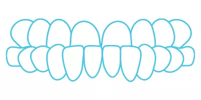Underbite