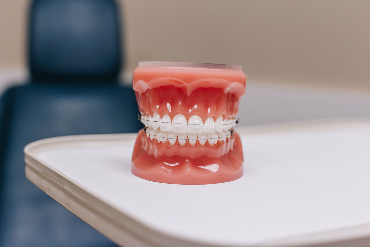 Crowded Teeth